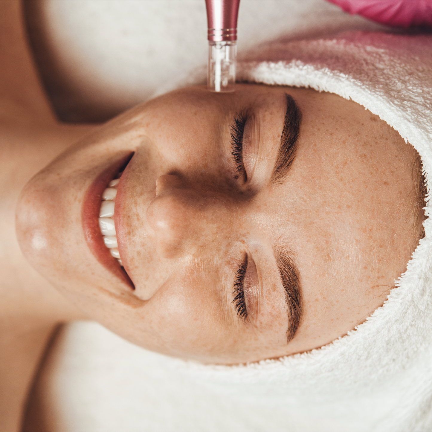 Microneedeling inkl. chemisches Flash Peeling